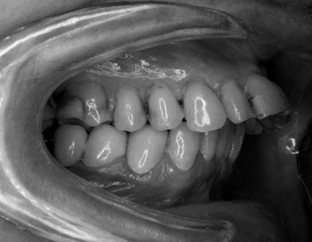 Výrazné vyklopenie – protrúzia rezákov u pacientky č. 1.
Fig. 1. Severe upper incisors protrusion in patient No. 1.