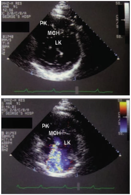 (a) Parasternální pohled v krátké ose ukazuje rozštěp předního listu mitrální chlopně, který je normálně přítomen u defektu typu ostium primum. (b) Barevná dopplerovská echokardiografie znázornila přidruženou mitrální regurgitaci.