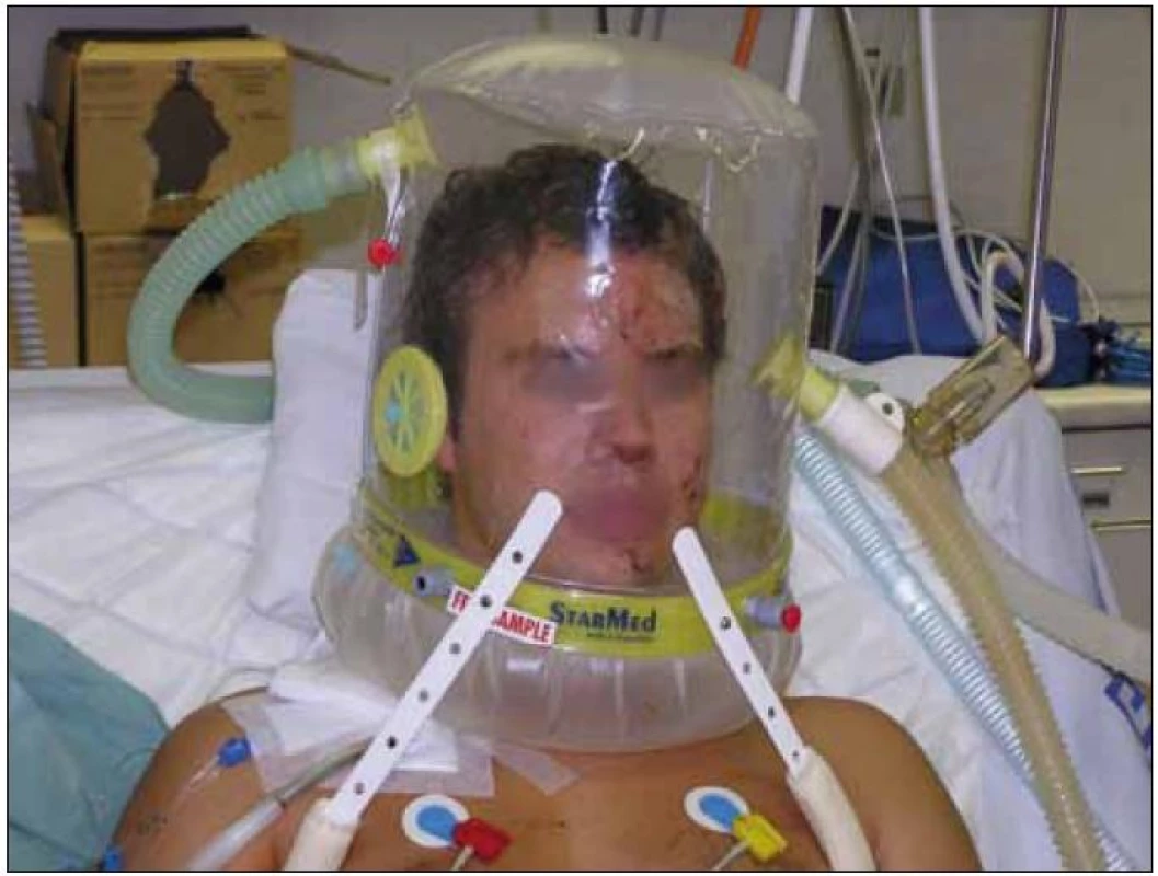 Helma pro neinvazivní plicní ventilaci.