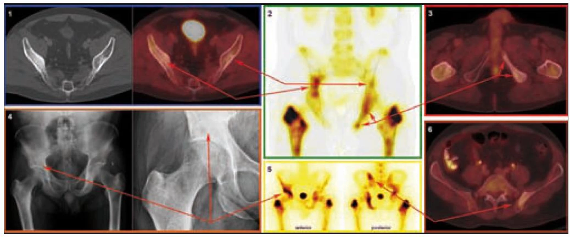 Charakteristická patologie v oblasti pánevního pletence z pohledu různých zobrazovacích modalit.

CT a PET/CT (1): Nepravidelná struktura s nápadnými sklerotickými okrsky, místy v terénu prořídlé struktury v oblasti obou lopat kostí kyčelních. PET komponenta zachycuje difuzně zvýšenou aktivitu FDG v místech strukturálních změn popisovaných na CT.

SPECT (2) a scintigrafie skeletu (5): Zvýšená aktivita radiofarmaka v oblasti kosti sedací a stydké vlevo, v oblasti kosti kyčelní vpravo a dále v oblasti levého sakroiliakálního skloubení.

PET/CT (3): Nepravidelná struktura s nápadnými sklerotickými okrsky, místy v terénu prořídlé struktury v oblasti levé kosti stydké a levé kosti sedací. PET komponenta zachycuje difuzně zvýšenou aktivitu FDG v místech strukturálních změn popisovaných na CT.

RTG (4): Mírné zahuštění struktury spongiózy v okolí pravého acetabula, krčku lopaty kosti kyčelní.

PET/CT (6): Nepravidelná struktura s nápadnými sklerotickými okrsky, místy v terénu prořídlé struktury vlevo v lopatě kosti kyčelní v blízkosti sakroiliakálního skloubení. PET komponenta zachycuje difuzně zvýšenou aktivitu FDG v místech strukturálních změn popisovaných na CT.