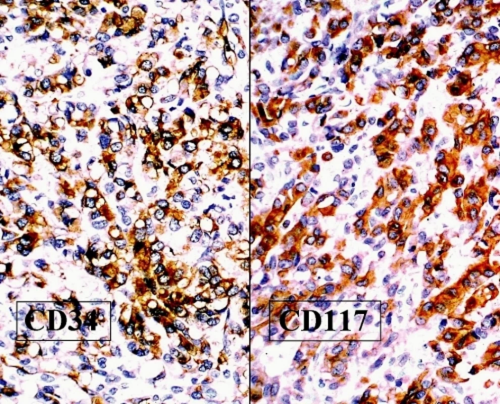 GIST. Difuzní a homogenní exprese antigenů CD34 (vlevo) a CD117 (vpravo) v nádorových buňkách (DAB, 200x)