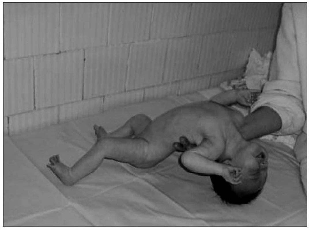 Kazuistika 2. Extrémna hypotónia u novorodenca ako dominantný príznak pre PWS.
Fig. 4. Case report 2. Extreme hypotonia in the newborn as a dominant symptom of PWS.