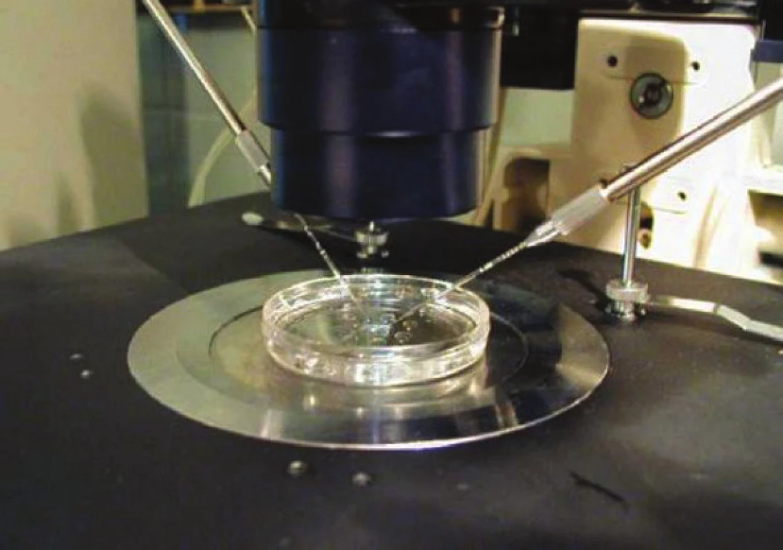Selekce spermií pomocí mikromanipulační pipety.