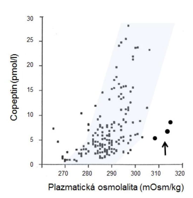 Vzťah medzi osmolalitou plazmy a plazmatickou koncentráciou kopeptínu u pacienta s dysgenézou corpus callosum a adipsickým diabetes insipidus počas 12-hodinového smädového testu. Šedá oblasť na obrázku označuje rozsah normálnych hodnôt u zdravých osôb [14]. V porovnaní s normálnymi hodnotami boli koncentrácie kopeptínu (označené plnými bodkami vpravo od šedej oblasti) nižšie, než by sa očakávalo pre danú hodnotu osmolality.

Fig. 3. Relationship between plasma osmolality and copeptide levels during 12 hours of water restriction in a patient with adipsic diabetes insipidus due to dysgenesis of corpus callosum. The grey area on the figure shows the physiological range in healthy subjects [14]. In this patient, plasma copeptide concentrations were lower, that it would be expected in healthy subjects for the same levels of plasma osmolality (shown by full dots outside of the grey area).