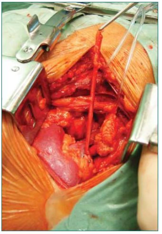 Ledvina po obnovení oběhu uložená v ilické jámě (před implantací močovodu).
