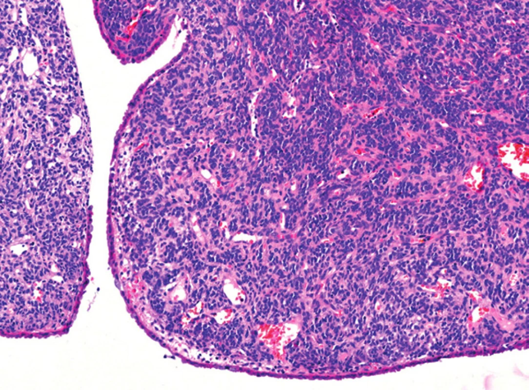 Solitární fibrózní tumor sestává z vřetenitých buněk vzhledu fibroblastů či myofibroblastů, mezi kterými jsou větvící se kapiláry. Na povrchu nádoru je oploštělý endometriální epitel (hematoxylin-eozin, původní zvětšení 200×)