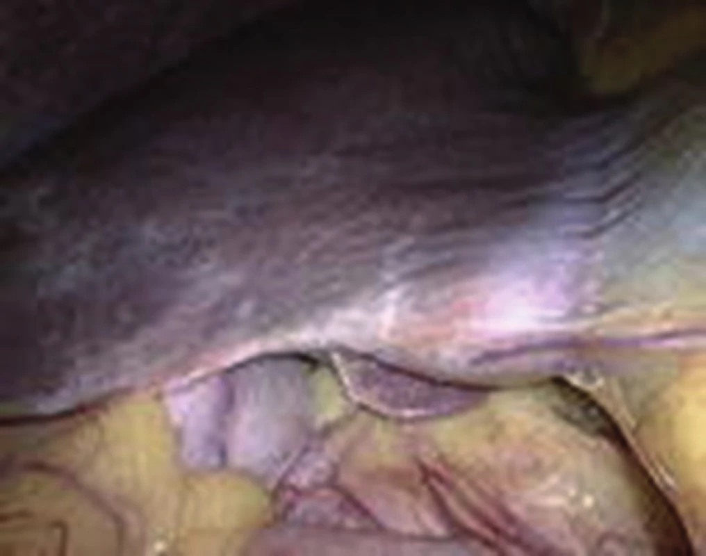 Jiný pacient s přestavbovou lézí paraligamentózně vpravo
Fig. 4: Architectural distortion to the right side of the falciform ligament in another patient