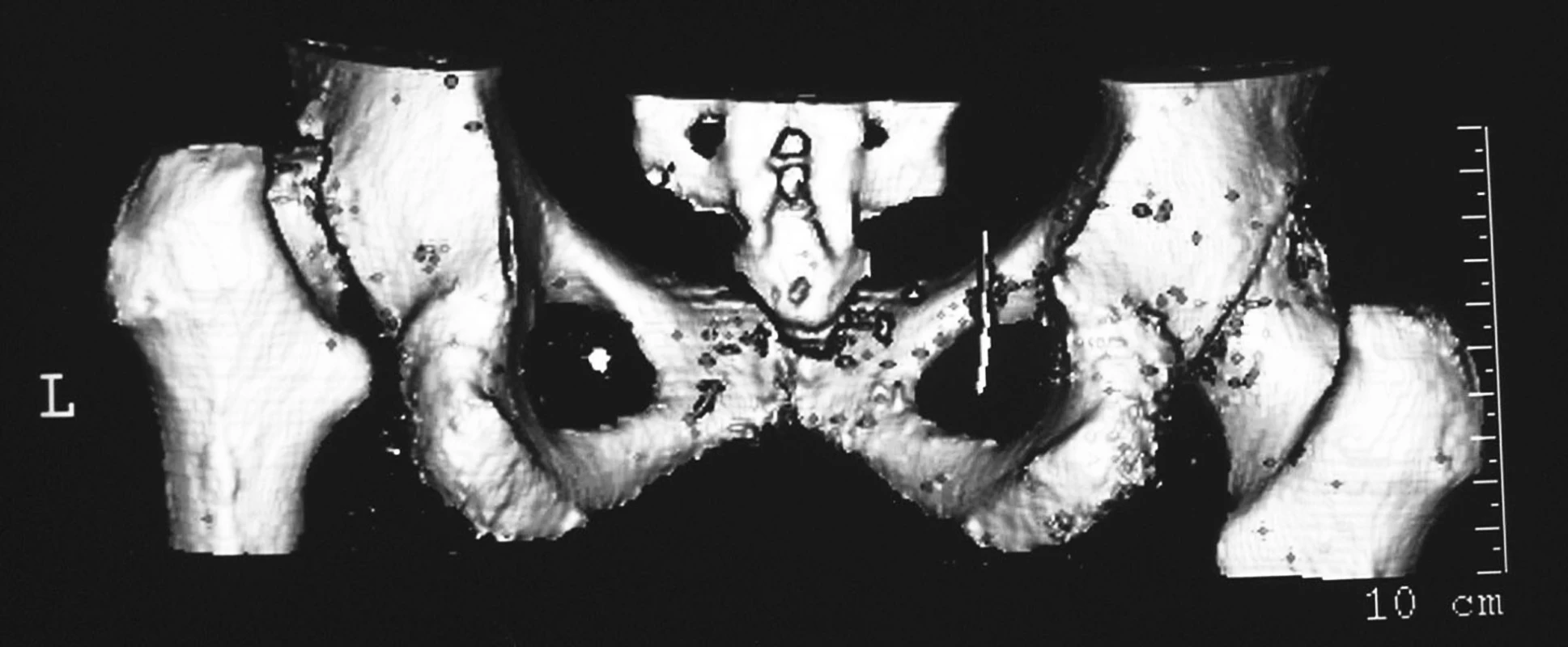 Trojrozměrná rekonstrukce CT obrazu hlavice femoru l.sin. – zkracení krčku.