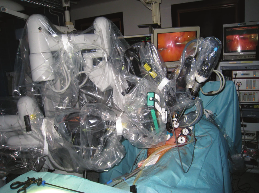 Umístění robotických ramen při operaci