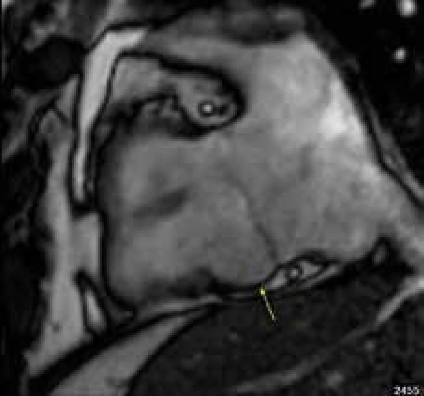 Lokalizované aneuryzma báze spodní stěny pravé komory v subtrikuspidální oblasti (žlutá šipka) u nemocného s arytmogenní kardiomyopatií pravé komory; projekce na vtok pravé komory