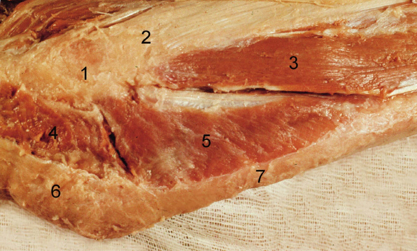 Povrchová vrstva svalů zevní plochy loketního kloubu (pravá strana): 1 – epicondylus lateralis humeri, 2 – m. extensor digitorum, 3 – m. extensor carpi ulnaris, 4 – caput radiale m. tricipitis brachii, 5 – m. anconeus, 6 – olecranon se šlachou m. triceps brachii, 7 – ulna. &lt;i&gt;(Převzato z Bartoníček J, Heřt J. Základy klinické anatomie pohybového aparátu. Praha, Maxdorf 2004.)&lt;/i&gt;
Fig. 3: Superficial layer of muscles of the lateral surface of the elbow (right side): 1 – lateral epicondyle of humerus, 2 – extensor digitorum, 3 – extensor carpi ulnaris, 4 – lateral head of triceps brachii, 5 – anconeus, 6 – olecranon with triceps brachii tendon, 7 – ulna. &lt;i&gt;(Reprinted from Bartoníček J, Heřt J. [Outline of Clinical Anatomy of Musculoskeletal Apparatus]. Praha, Maxdorf 2004.)&lt;/i&gt;