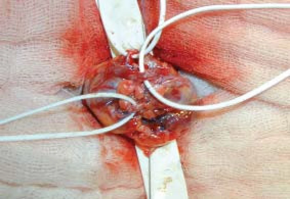 Identifikace testikulární arterie a přerušení testikulárních žil.