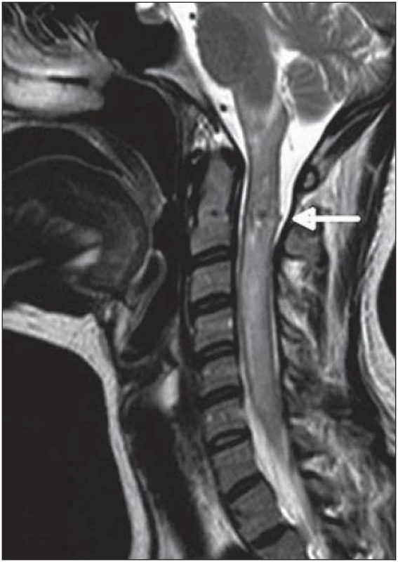 MR krční páteř T2 TSE – patologický signál míchy od zadní jámy až po Th4 v rámci edému, nehomogenní signál v etáži C2 odpovídající AVM se zakrvácením.
