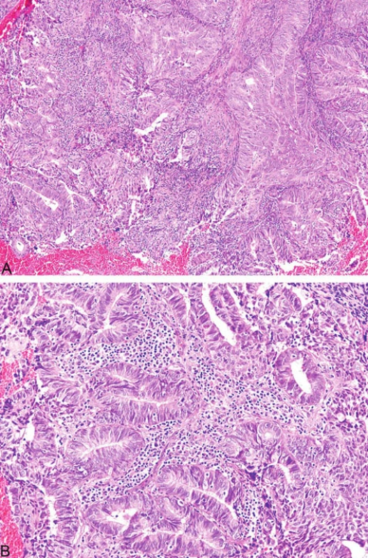 Endometriální endometroidní karcinom s peri- a intratumorální lymfocytární infiltrací (A, B)