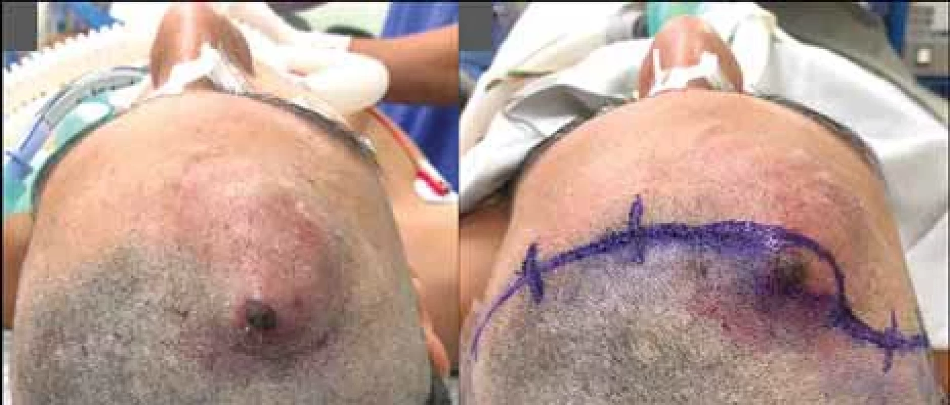 Photograph of the preoperative appearance of the skin before (A) and after (B) the surgical incision marking.