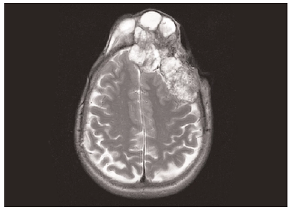 MR zobrazovacie vyšetrenie demonštrujuce intrakranialnu expanziu nadoru s kompresiou mozgových hemisfer. Snimka poskytnuta laskavosťou prim. MUDr. Ivana Mačugu.
