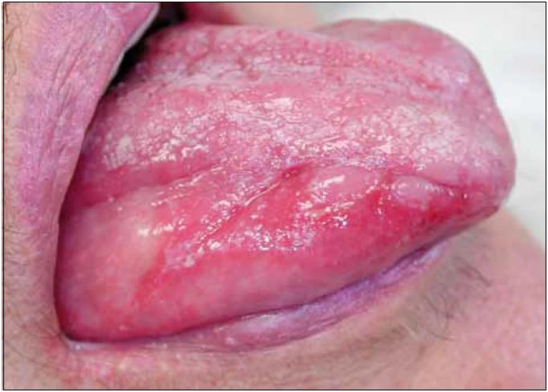 Orální lichen planus (kazuistika 1). Pohled na pravou stranu jazyka pacientky s projevy orálního lichen planus v podobě depapilované sliznice, erytému a vícečetných erozí. Na hřbetu jazyka a na červeni dolního rtu viditelné diskrétní bělavé hyperkeratózy.