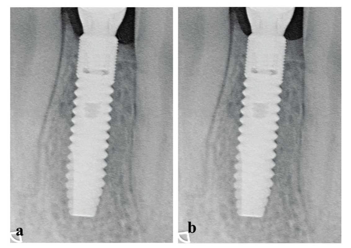 Změna oseointegrace po pěti letech od implantace (přírůstek: + 2 mikrozávity = implantát 4 OS – 2 x 0,14 mm = 0,28 mm přírůstek kosti)