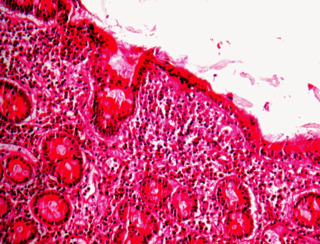 Detailný záber na vyhladenú sliznicu tenkého čreva s chronickým zápalom intraepitelových lymfocytov. HE, 200krát