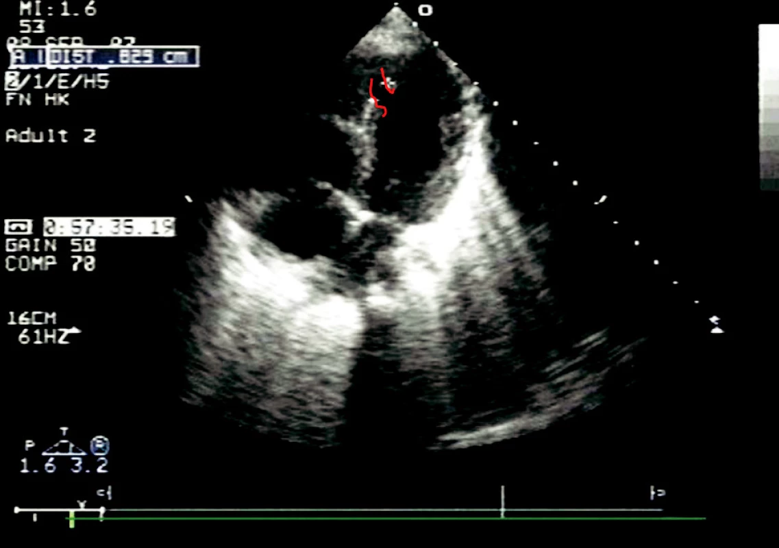 Apikální čtyř dutinová projekce, červeně je zvýrazněn defekt septa komor, kterým vzniká levo-pravý zkrat
Fig. 2. Apical projection of the four chambers, the ventricular septal defect, forming a left-to-right shunt, is highlighted in red