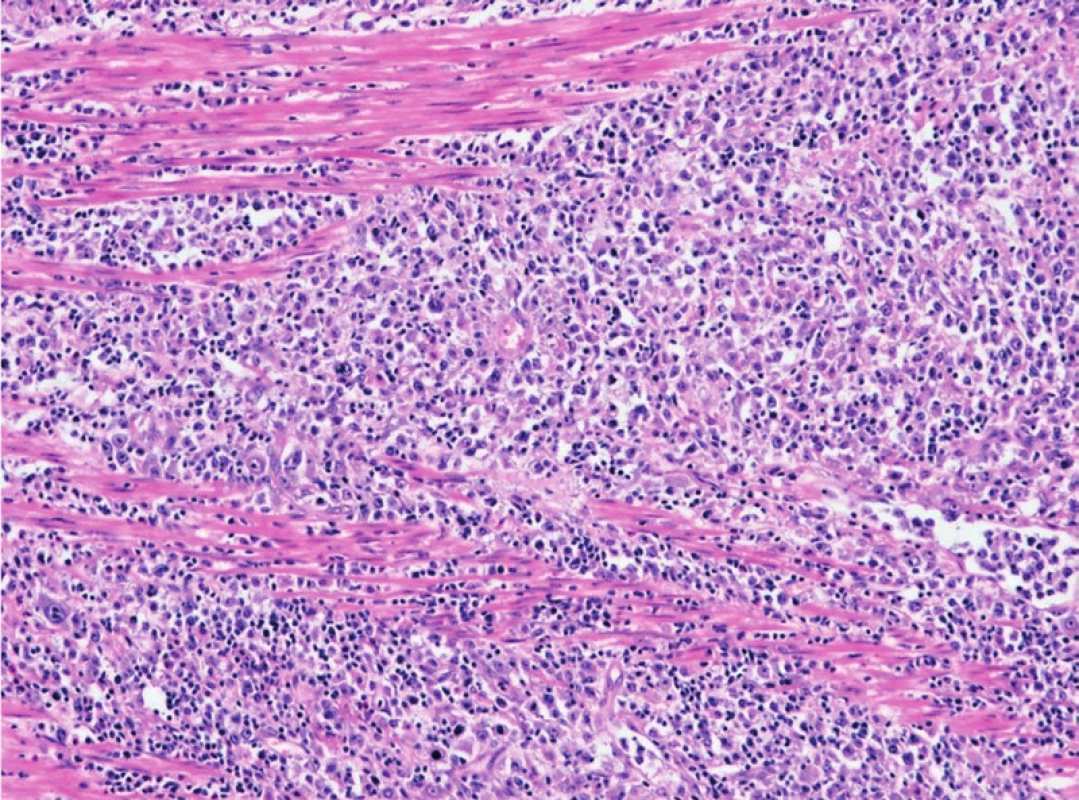 Infiltrace tlustého střeva – muscularis propria – DLBCL (hematoxylin-eosin, zvětšení 100x).