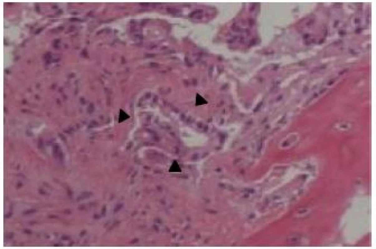 Bone marrow biopsy. Hematoxylin and eosin staining of the bone marrow biopsy performed at the left iliac revealed adenocarcinoma cells (×400, black arrowheads)