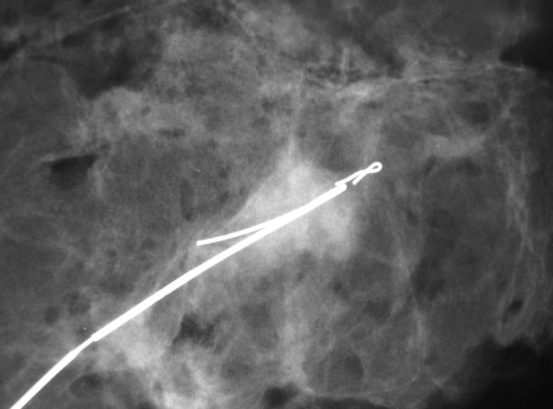 Mamografický obraz resekátu s označením místa po biopsii klipem a předoperačně stereotakticky zavedeným drátkem s kotvičkou k identifikaci ložiska při operaci