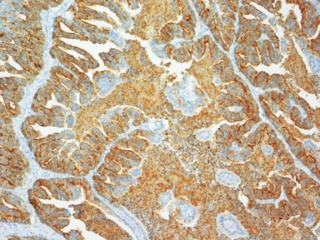 Metastáza karcinomu prostaty do nadvarlete – cystopapilární duktální struktura IMH PSA (zvětšeno 100x)
Fig. 2. Epididymal metastatis of prostate cancer – cystopapillary structure IMH PSA (zoom 100x)
