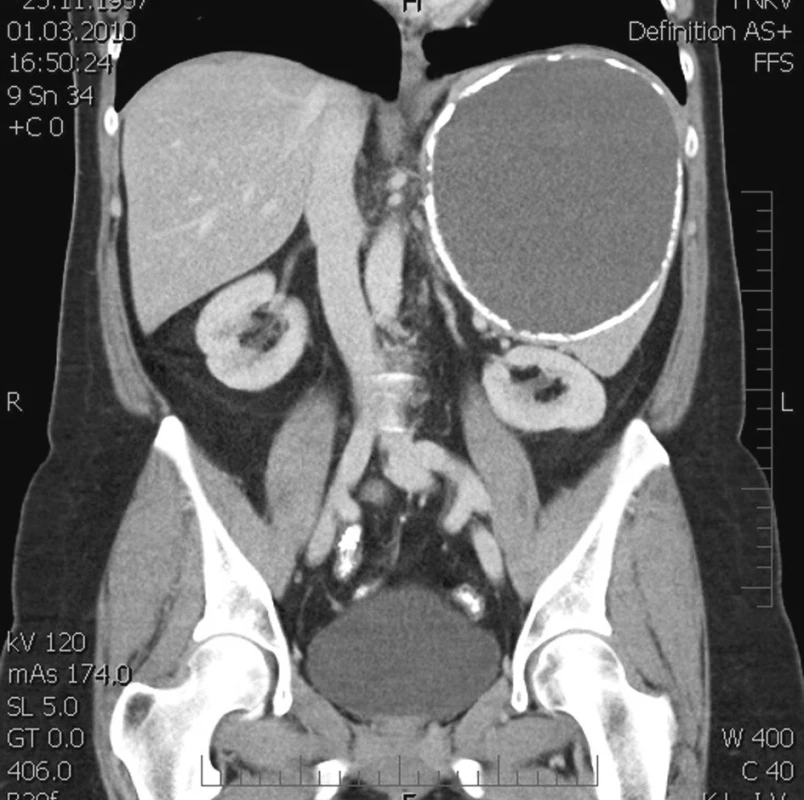 Poúrazová pseudocysta sleziny v CT scanu – koronární řez
Fig. 2. Post-traumatic pseudocyst of the spleen on CT scan – coronary section
