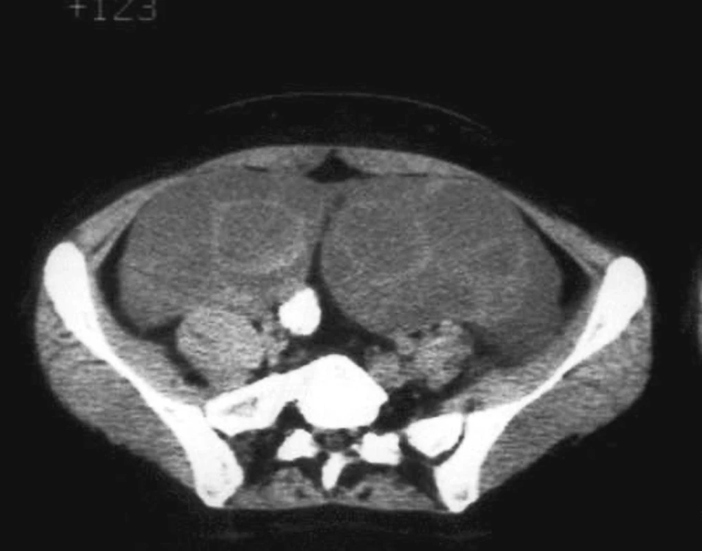 Počítačová tomografia: abdomen s multicystickým tumorom a slabo sa sýtiacimi septami
Fig. 2. Computed tomography: abdomen with multicystic tumor and poorly enhanced septae