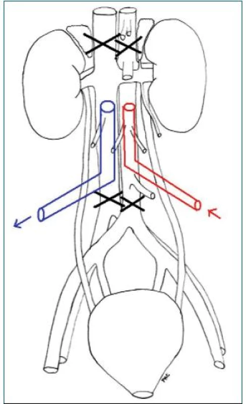 Schéma kanylace aorty a dolní duté žíly.