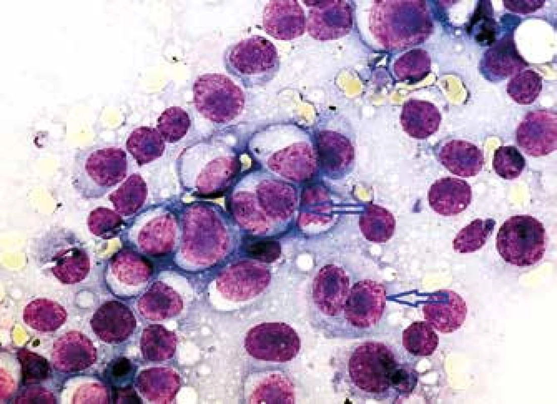 Plazmablastický lymfom jakožto transformace CD5+ MZL (infiltrace lymfatické uzliny plazmablasty – velkými lymfoidními/ plazmocytoidními elementy s bohatou bazofilní cytoplazmou, excentricky lokalizovaným jádrem s méně kondenzovaným jaderným chromatinem a četnými bazofilními nukleoly, přítomny jsou i dvoujaderné plazmablasty – označeny šipkami)