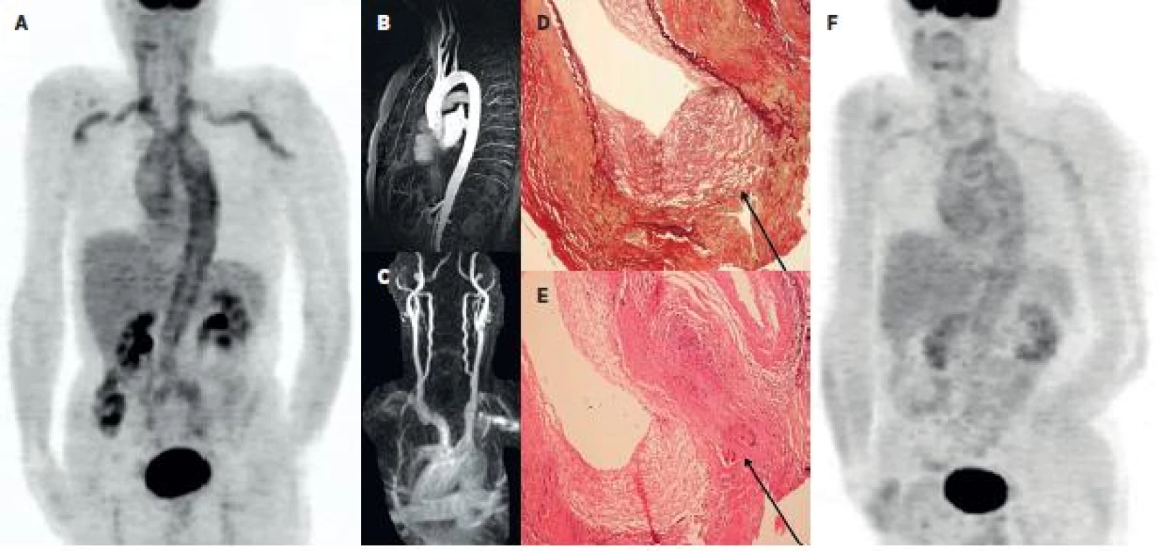 Kazuistika – muž 65 let 2A: PET MIP trupu ve fázi metabolicky aktivní vaskulitidy provázené laboratorními i klinickými známkami zánětlivého onemocnění. Je patrna vysoká akumulace FDG v aortě a v některých velkých tepnách (truncus brachiocephalicus, a. carotis communis bilat., a. subclavia a a. brachialis bilat.). 2B a 2C: Při podezření na vaskulitidu bylo provedeno MRA vyšetření aortálního oblouku a krčních tepen – bez průkazu známek vaskulitidy. Excize temporální tepny ale potvrdila obrovskobuněčnou, temporální arteritis - 2D: barvení na elastická vlákna zv. 100x, průkaz rozpadu lamina elastica interna (označeno). 2E: HE, zv. 100x, průkaz vícejaderných buněk (označeno). 2F: Kontrolní PET vyšetření po 8 měsících terapie glukokortikoidy prokazuje pokles akumulace FDG ve velkých tepnách.