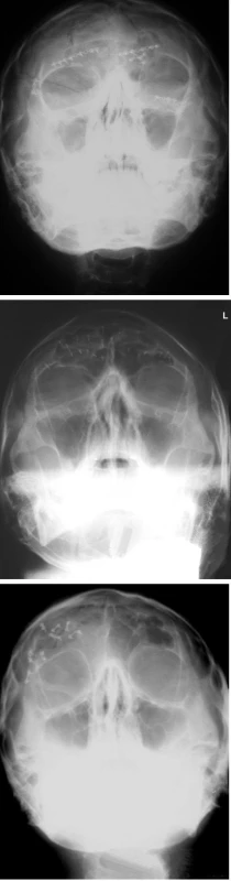 Röntgenové snímky pacientov s kraniofaciálnym poranením.