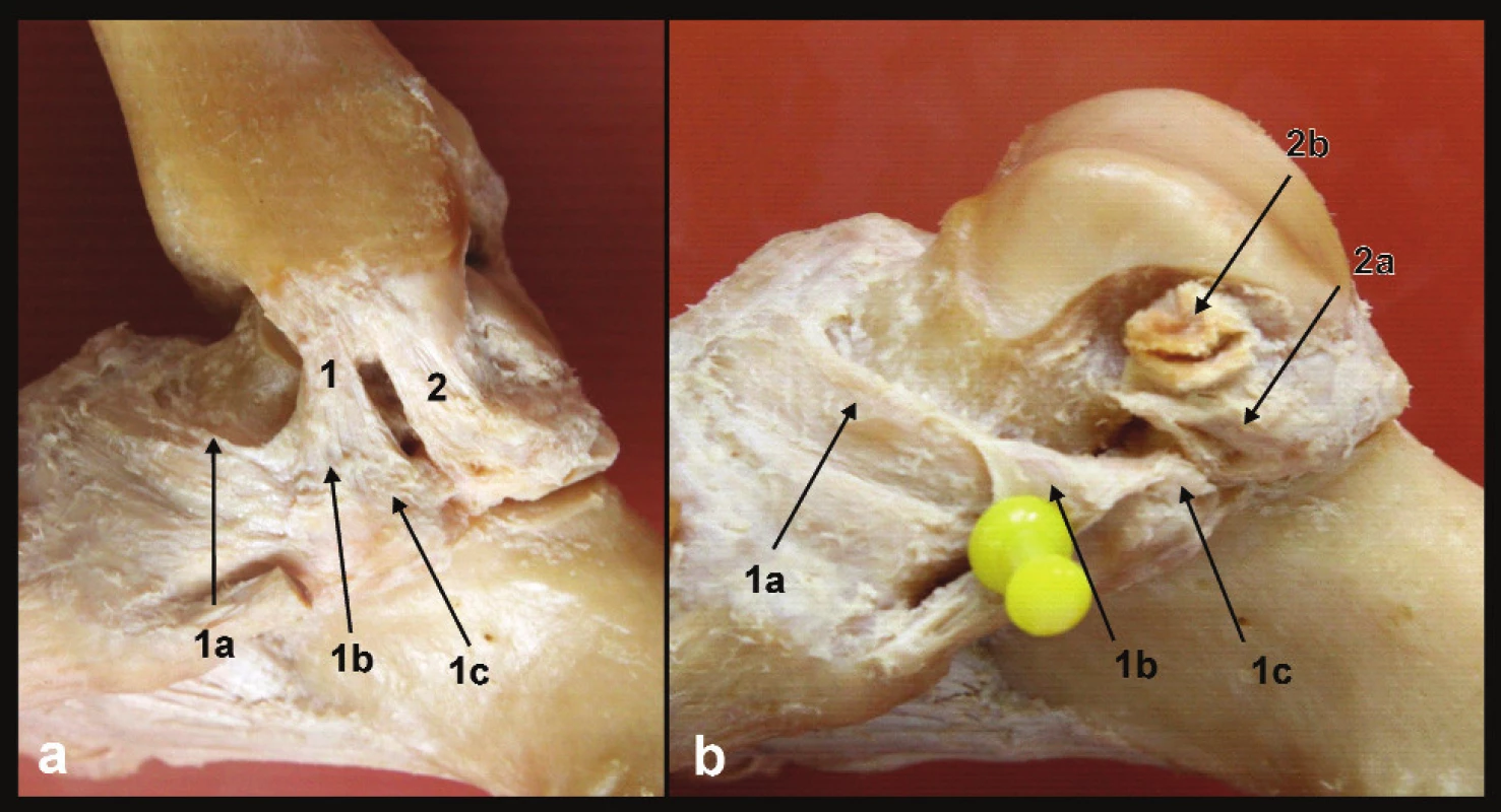Anatomie deltového vazu, pravé hlezno a – pohled z mediální strany, b – stav po odstranění tibiofibulární vidlice, 1 – přední tibio-subtalární část deltového vazu, 1a – tibionavikulární vlákna, 1b – tibio-„spring“ vlákna, 1c – tibiokalkaneární vlákna, 2 – zadní tibio-talární část deltového vazu, 2a – talární úpon vertikálních povrchových vláken, 2b – talární úpon hlubších horizontálních vláken