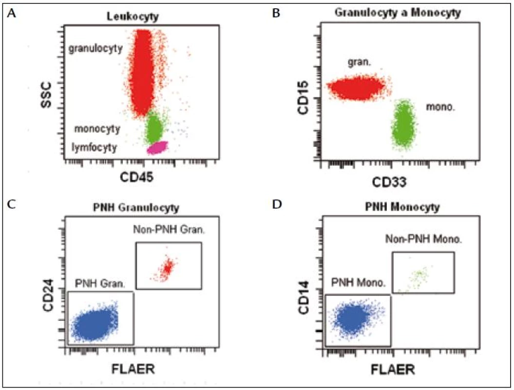 Leukocyty (lymfocyty, monocyty a granulocyty) definujeme na základě parametrů CD45/SSC (A). Granulocyty jsou CD15&lt;sup&lt;silně+&lt;/sup&lt;/CD33&lt;sup&gt;slabě+&lt;/sup&gt;, monocyty CD15&lt;sup&gt;slabě+&lt;/sup&gt;/CD33&lt;sup&gt;silně+&lt;/sup&gt; (B). PNH granulocyty jsou FLAER&lt;sup&gt;neg&lt;/sup&gt;/CD24&lt;sup&gt;neg&lt;/sup&gt; (C), PNH monocyty jsou FLAER&lt;sup&gt;neg&lt;/sup&gt;/CD14&lt;sup&gt;neg&lt;/sup&gt; (D).