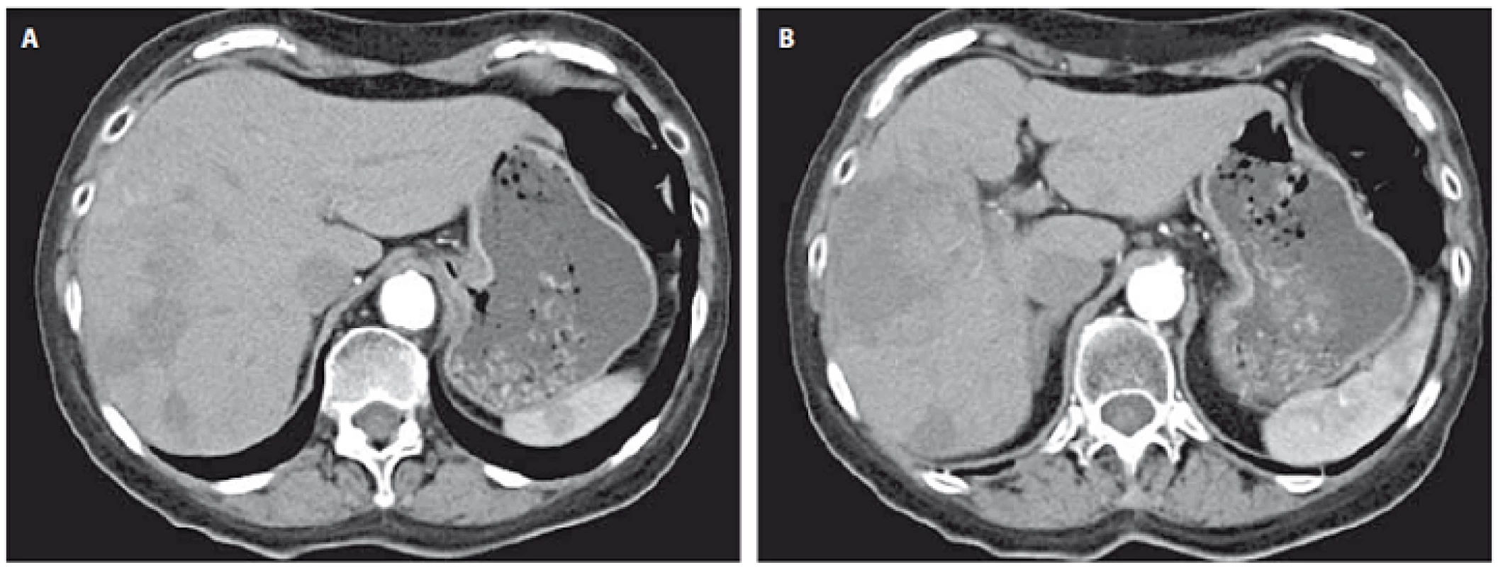 CT image prior to first TACE procedure (A) and after second TACE procedure showing partial right lobe necrosis (B).