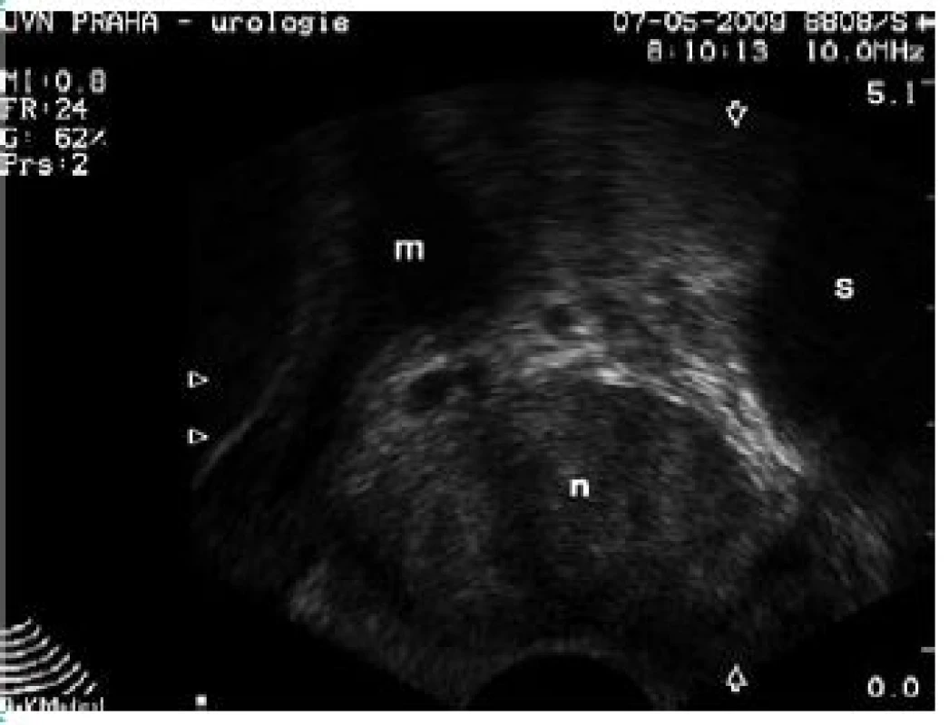 Kazuistika 1 – transvaginální ultrazvuk: sférická solidní struktura v kaudální části uretrovaginálního septa
Fig. 1 Case report 1 – transvaginal ultrasound: spheroid solid lesion in the caudal part of urethrovaginal septum