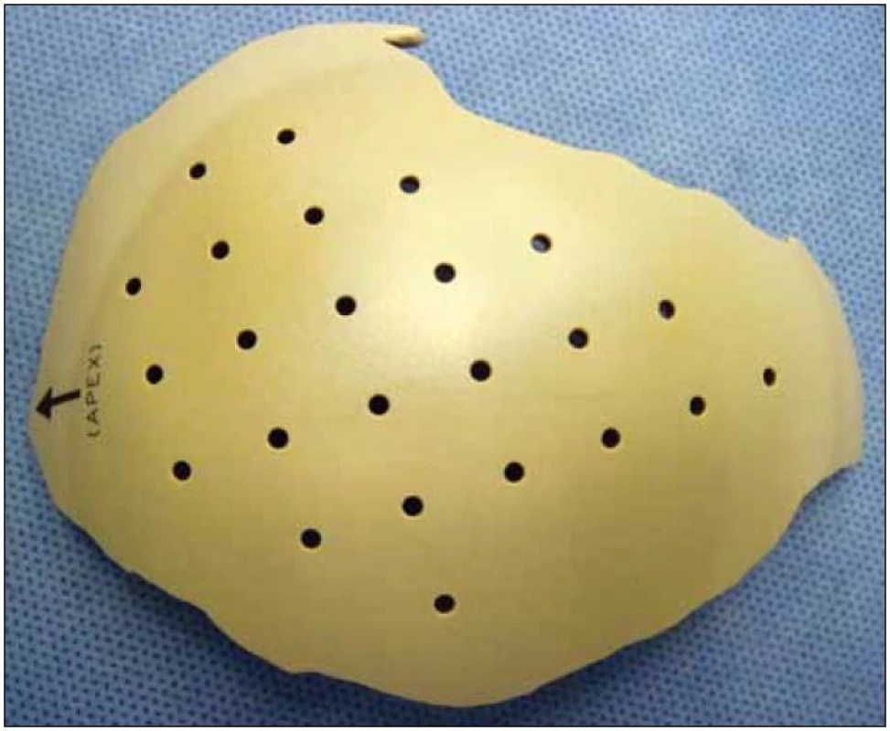 Biokompatibilní implantát vyhotovený na míru podle tvaru a velikosti defektu.