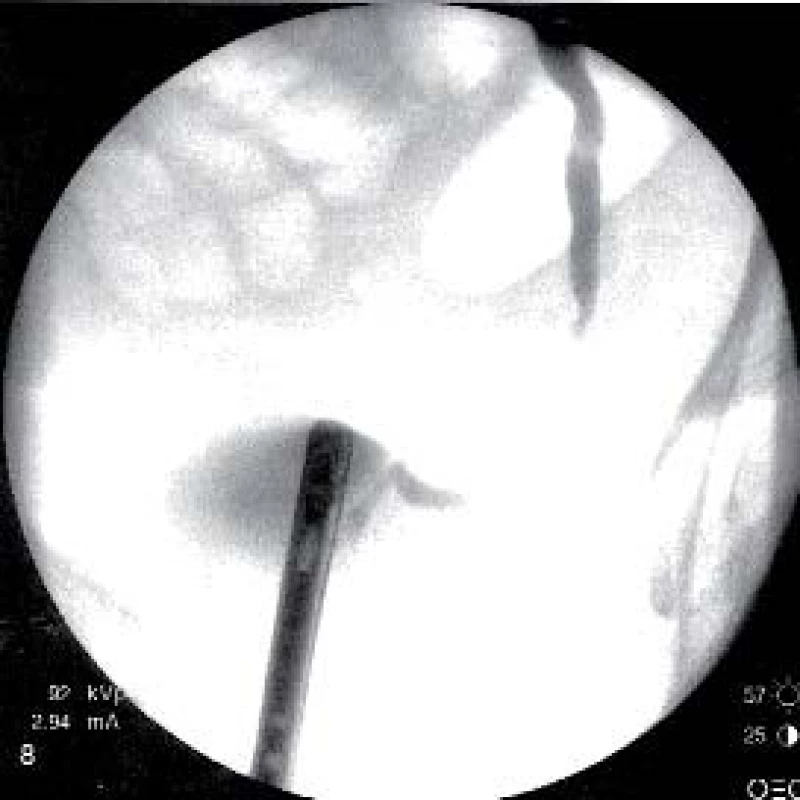 Zobrazení distální stenózy močovodu vlevo.