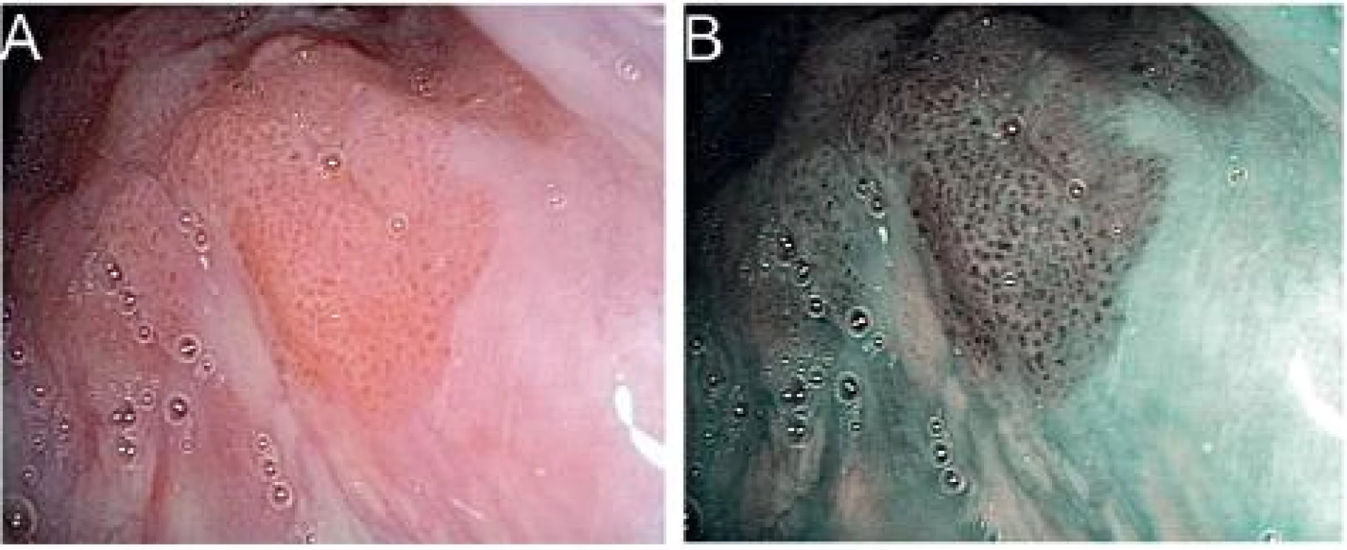 Slizniční šíření dlaždicobuněčného karcinomu na kořeni jazyka v bílém světle (A) a NBI (B). V NBI režimu je jasně viditelné ostré ohraničení mezi tumorem a zdravým epitelem.