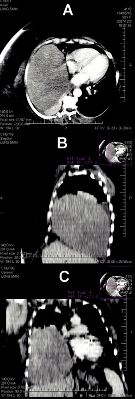 CT vyšetrenie zobrazujúce obrovský v.s. benígny cystoidný útvar vpravo s dystelektáziou pľúcneho parenchýmu (A – transverzálny rez; B – sagitálny rez; C – frontálny rez)
Fig. 2. CT examination depicting large, v.s. benign cystoid formation on the right, with dystelectasy of the lung parenchyma (A – transverse section; B – saggital section; C – frontal section)