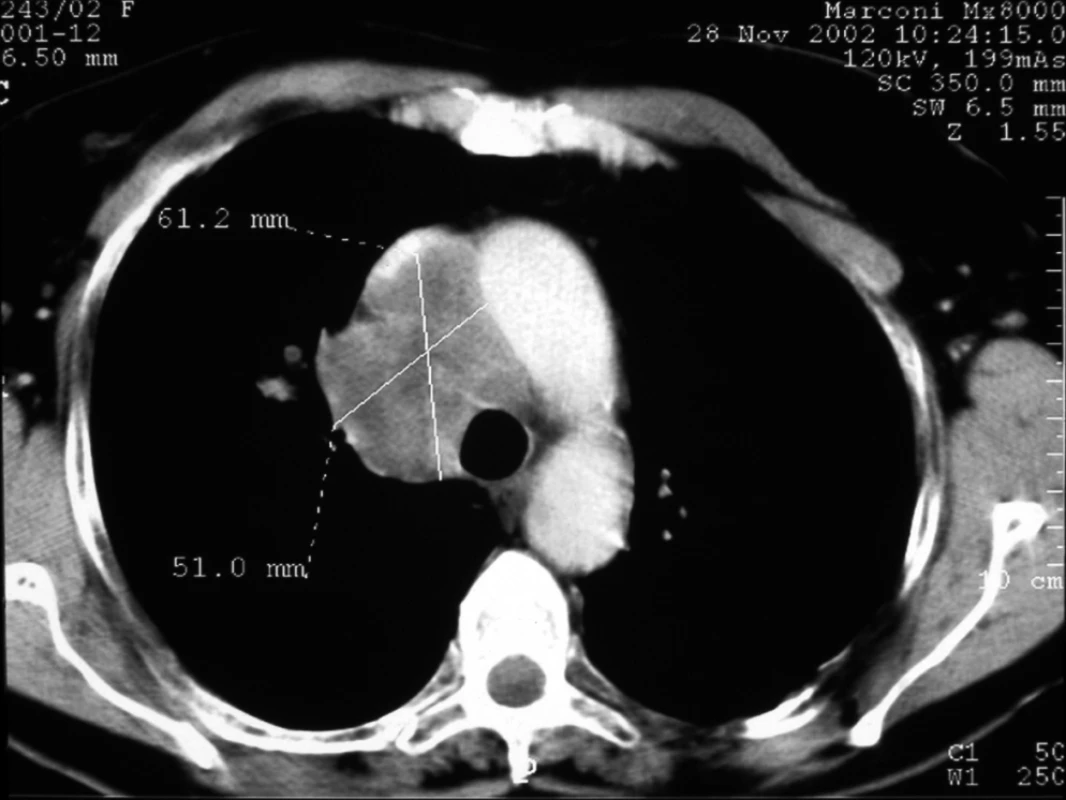 Infiltrát horního mediastina v CT obraze.