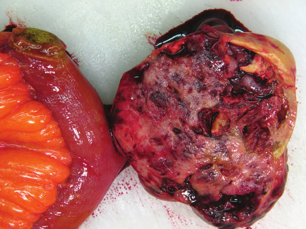 Gastrointestinální stromální tumor ilea
Fig. 3: Gastrointestinal stromal tumor of the ileum