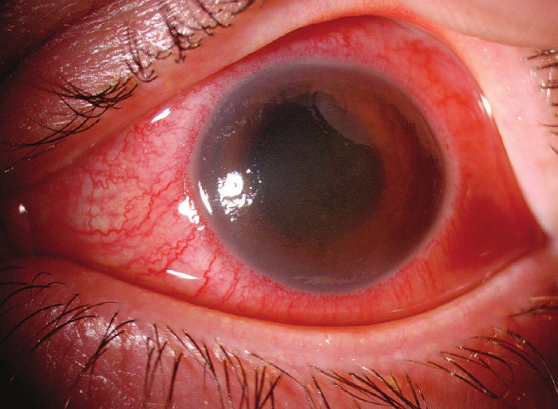 Pacient č. 2 - Přední segment levého oka s akutní hypertenzní přední uveitidou – květen 2009 (snímek Oční kliniky VFN)