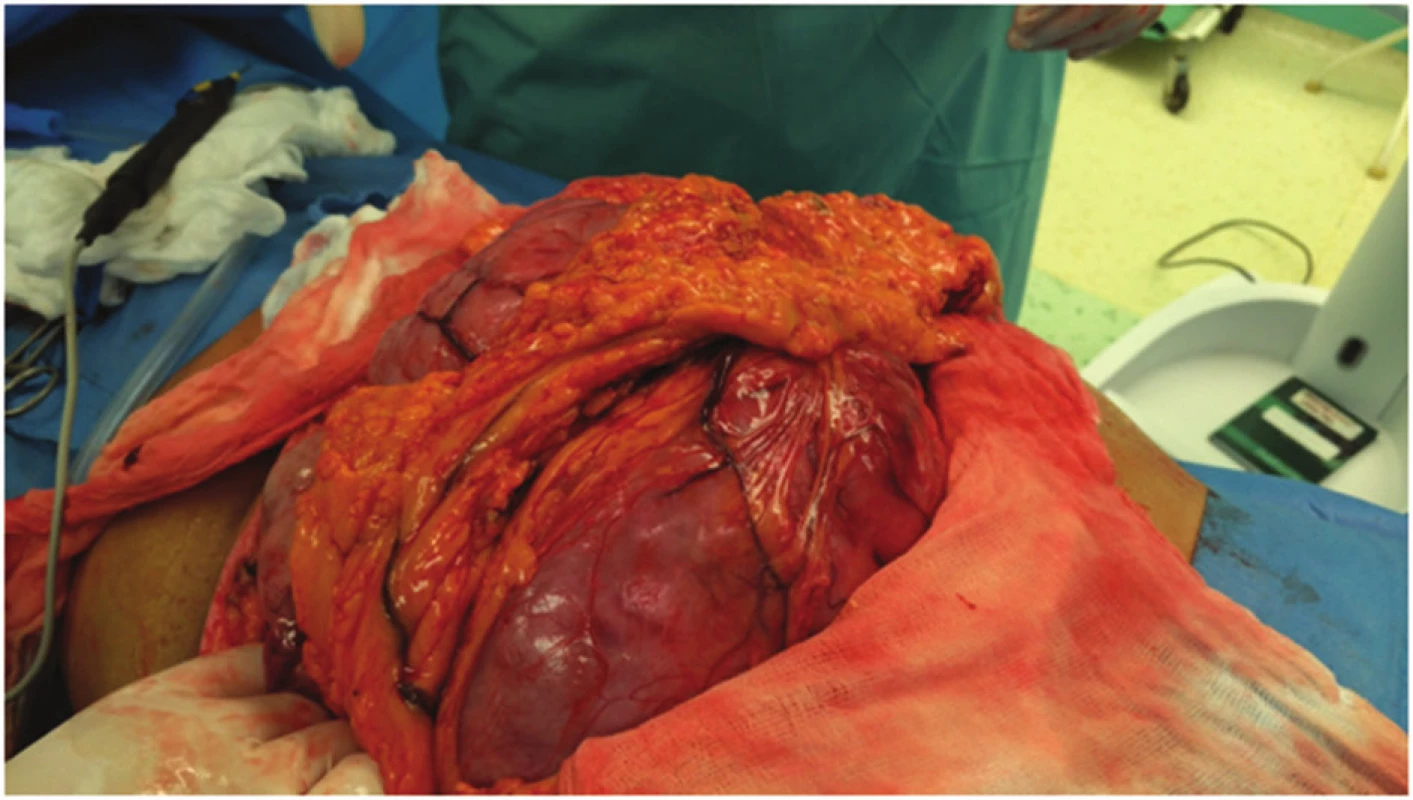 Peroperační nález-postupná luxace tumoru do příčné laparotomie
Fig. 3: Intraoperative finding – progressive dislocation of the tumor to transverse laparotomy