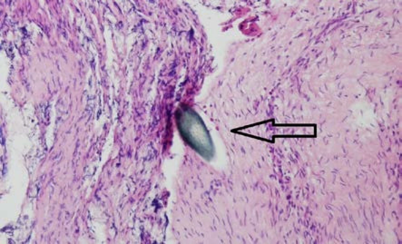 Histologie – kořenová anastomóza s viditelným stehem, barvení HE, zvětšení 40×
Fig. 8. Histology – spinal root anastomosis with visible stitch, HE staining, zoom 40×