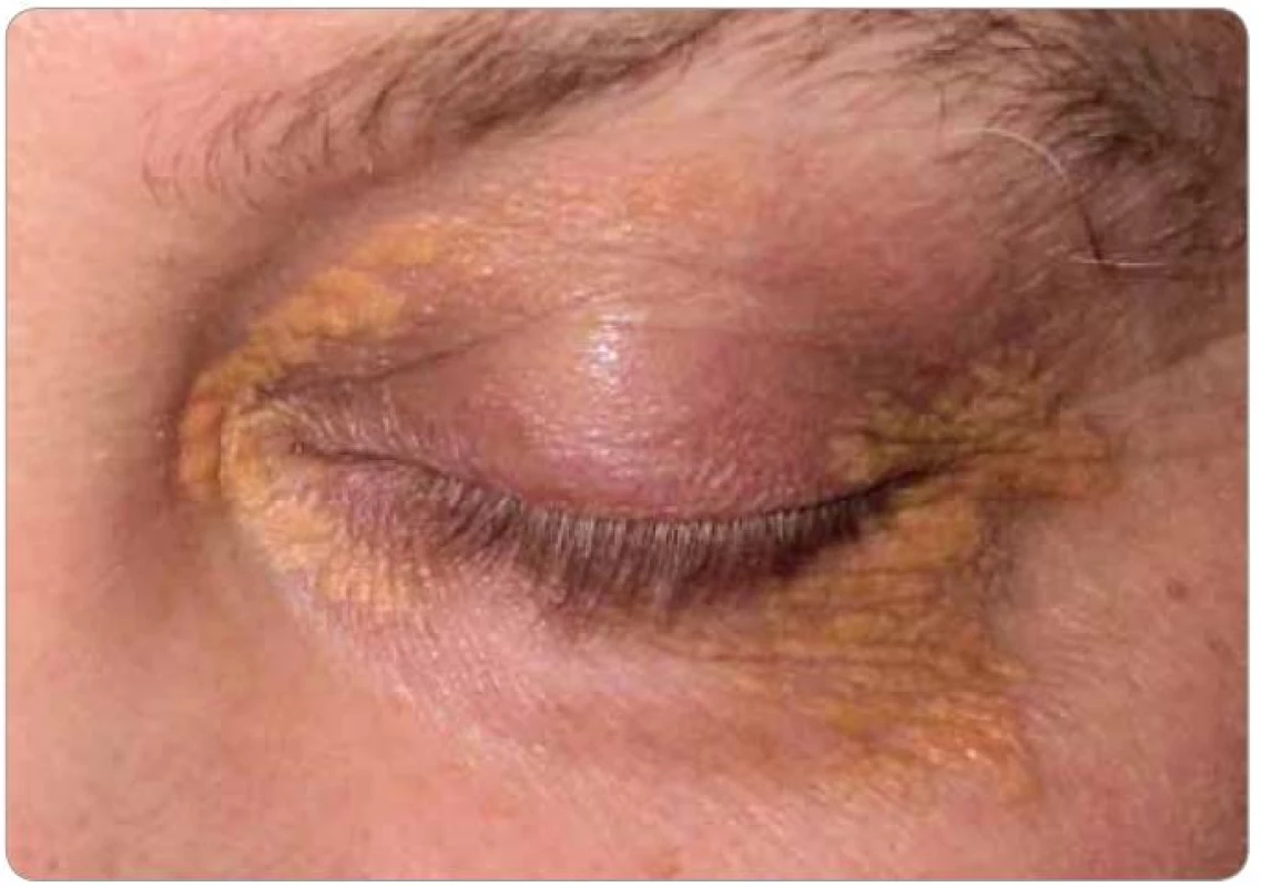 Xantalesma kolem očí pacienta, která se postupně zvětšují.