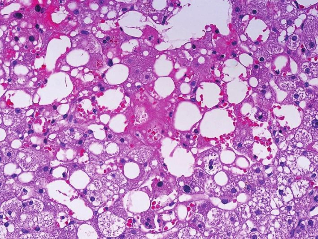 Lipopelióza v centrolobulární oblasti po transplantaci jater s vyšším stupněm steatózy. Tukové kapky jsou v sinusech a klinicky mohou navozovat poruchu prokrvení s tzv. periferní rezistencí (HE, objektiv 40x).