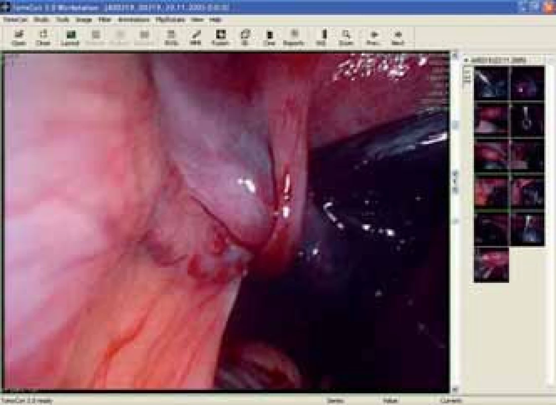 Snímek z laparoskopie - torze adnex.